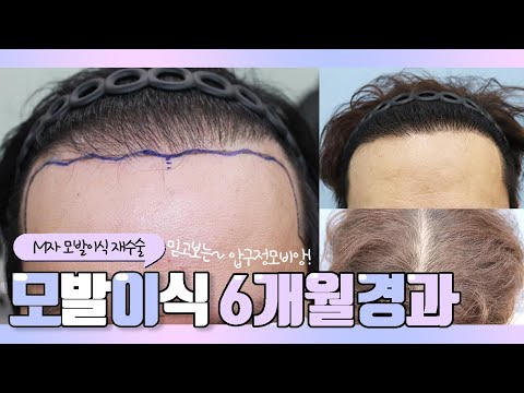 타 병원에서 2번수술 후 재수술,30대 후반 남성,비절개,4000모,M자 밀도보강 모발이식 6개월경과