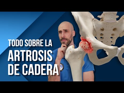 ¿Por qué se produce la artrosis en la cadera? ¿Qué soluciones hay?