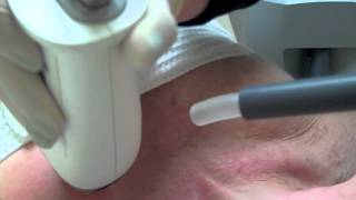 preview picture of video 'LaserDerm Skin Care Center: Fraxel® Laser Resurfacing'
