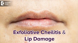 Exfoliative Cheilitis & its effect on Lips | DRY LIPS-Best Treatment-Dr.Rasya Dixit| Doctors