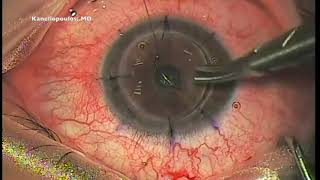 Download Lagu Penetrating keratoplasty for advanced keratoconus - Kanellopoulos, MD Thumbnail