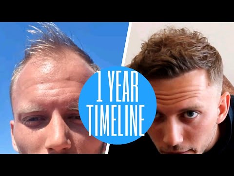 Hair Transplant – 1 year timeline