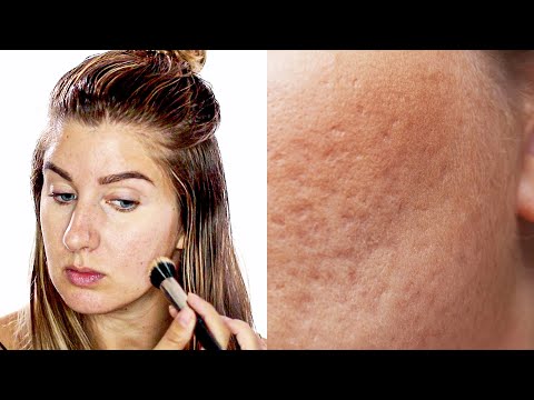 Do's And Don'ts To Applying Makeup On Pitted Acne Scars / Icepick Scars/ Boxcar scars