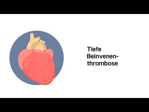 Tiefe Beinvenenthrombose - Erkrankungen der Gefäße und des Kreislauf