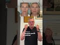 How I Got Into Lipografting (Fat Grafting) for Facial Rejuvenation