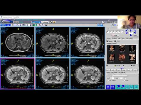 Bizarre liver masses (Dx small vessel neoplasm of uncertain malignant potential | Victoria Chernyak)