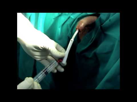 Massaggio prostatico per compiacere un uomo Medicina prostagut Fort prezzo