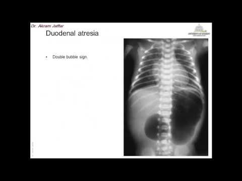 Embryologie angeborener Anomalien des Vorderdarms (2)