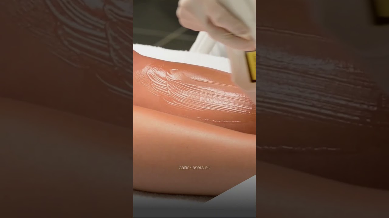 Baltic Lasers - Laser epilation machines