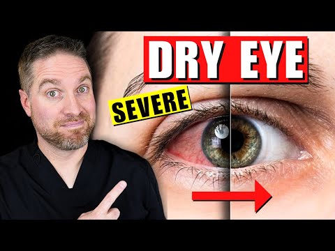 Top Treatments for Severe and Chronic Dry Eyes!
