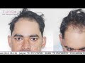 Avail the Best Hair Transplant by Dr. Suneet Soni at Medispa