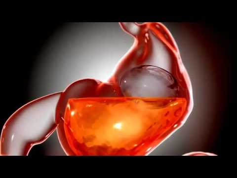 Obalon   How it works SD