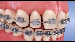 Orthodontie - Comment resserrer ses dents avec des bagues