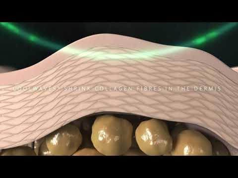 2019 Onda: mechanism of action