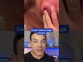 Huge abscess! This one is dangerous! | 208SkinDoc