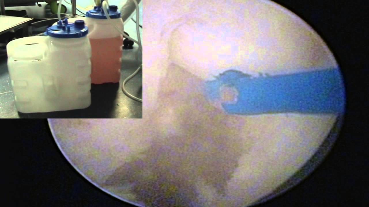 Watch video Enucléation laser de la prostate HOLEP - Symposium Urologique d'Aquitaine 2013 Enucléation laser de la prostate HOLEP - Symposium Urologique d'Aquitaine 2013