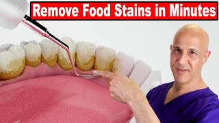 Quickly Remove Food Stains From Teeth | Dr. Mandell
