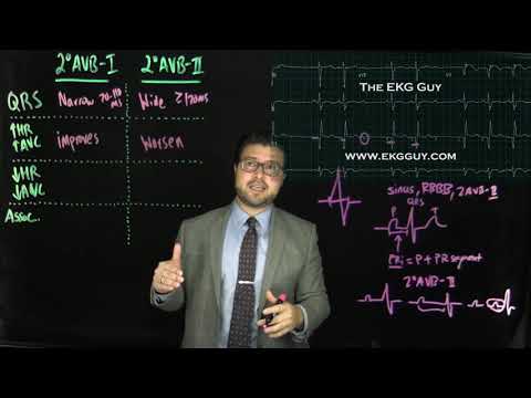 Second degree AV block simplified | The EKG Guy - www.ekgguy.com