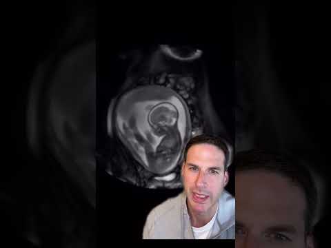 28 weeks of gestation in your #pregnancy ? What's going on now? #SummerOnShorts #preemie