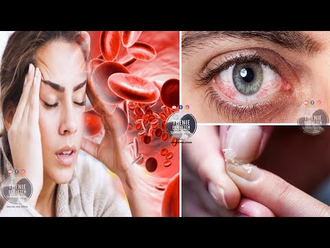 Mund të vuani nga anemia dhe të mos e dini, nëse keni këto simptoma menjere shkoni tek mjeku