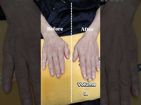 Hand Rejuvenation | Restylane Skin Booster Result