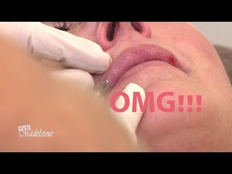 Anjas Mädelstour - Lippen aufspritzen, Haare entfernen - tut das weh?