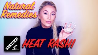 How To Get Rid Of Heat Rash | Natural Remedies