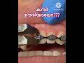 The Day The Braces Are Removed Braces Kambi Malayalam Dentist Viral Shorts Pallilkambiid