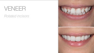 Direct Veneer Case by Dr. Claudio Novelli