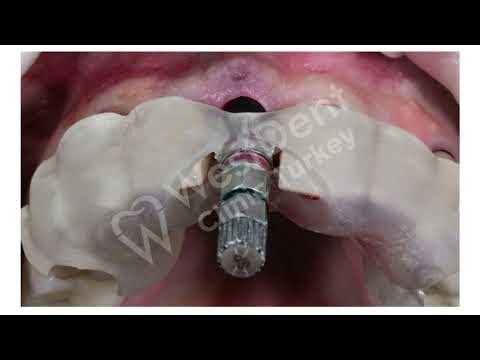 Logo of Computer Guided Dental Implant Procedure in Izmir, Turkey: A Comprehensive Guide