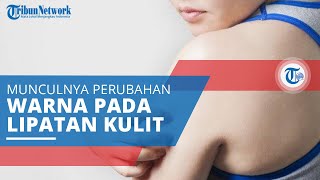 Akantosis Nigrikans, Kondisi pada Kulit Ditandai Perubahan Warna Gelap di Sekitar Lipatan Tubuh