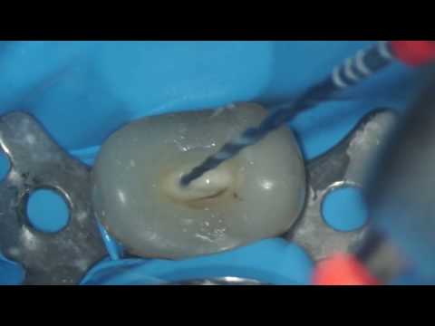 VDW Dental · Grande & Plotino: RECIPROC blue - Step by step preparation (clinical video)