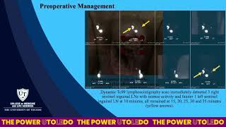 Core Videos (2025): Penile Cancer: Dynamic Sentinel Lymph Node Biopsy