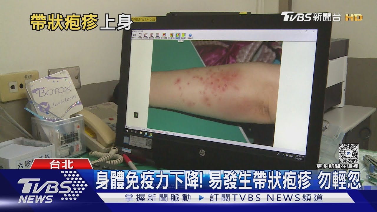 皮蛇上身痛到像刀割!帶狀疱疹恐終生神經痛 醫師:別做這件事!