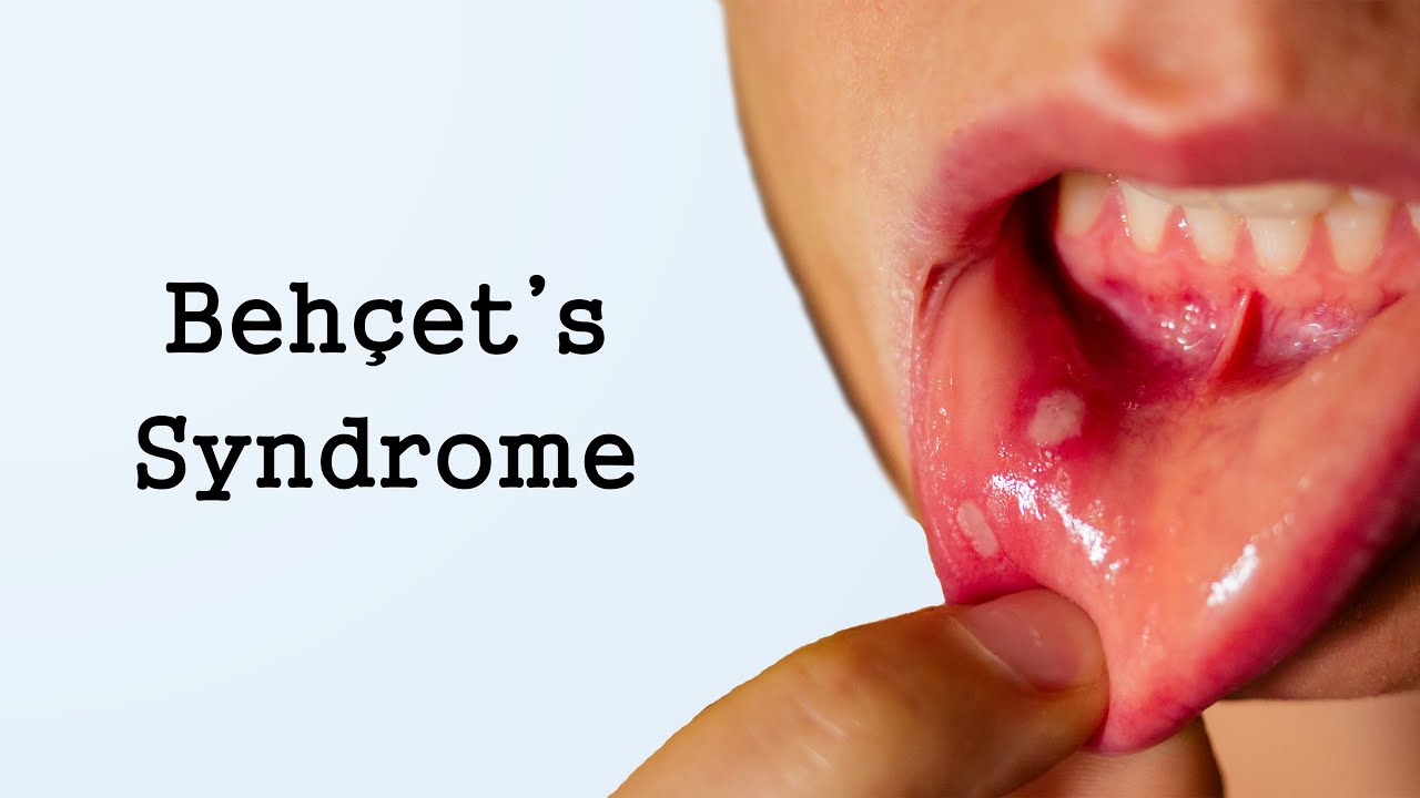 Behcet's Syndrome