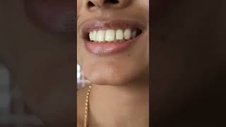 NO BRACES  Smile makeover in 2 weeks  for gaps and mild protrusion by  Cosmetic Dentist Dr Trivikram