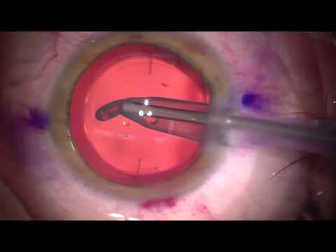 Afectiuni si tratamente, Chirurgia cataractei viziune după