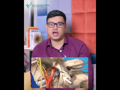 Severe Leg Pain & Slip Disc: A Patient’s Journey to Recovery | Dr. Mayukh Guha