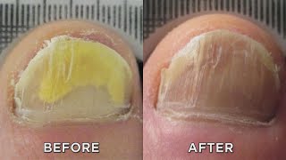 Nail Fungus Zap It with New Laser Treatment!