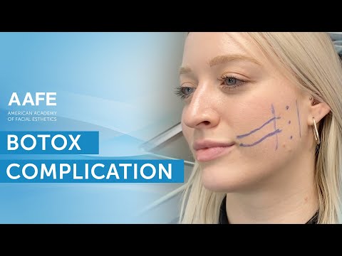 What Happened To Her Smile After Botox Injection | AAFE