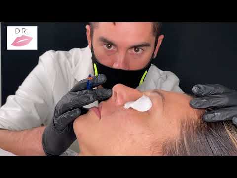Video Rinofiller — Dr Lips