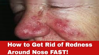 Red Nose No More: How to Get Rid of Redness Around Nose FAST!