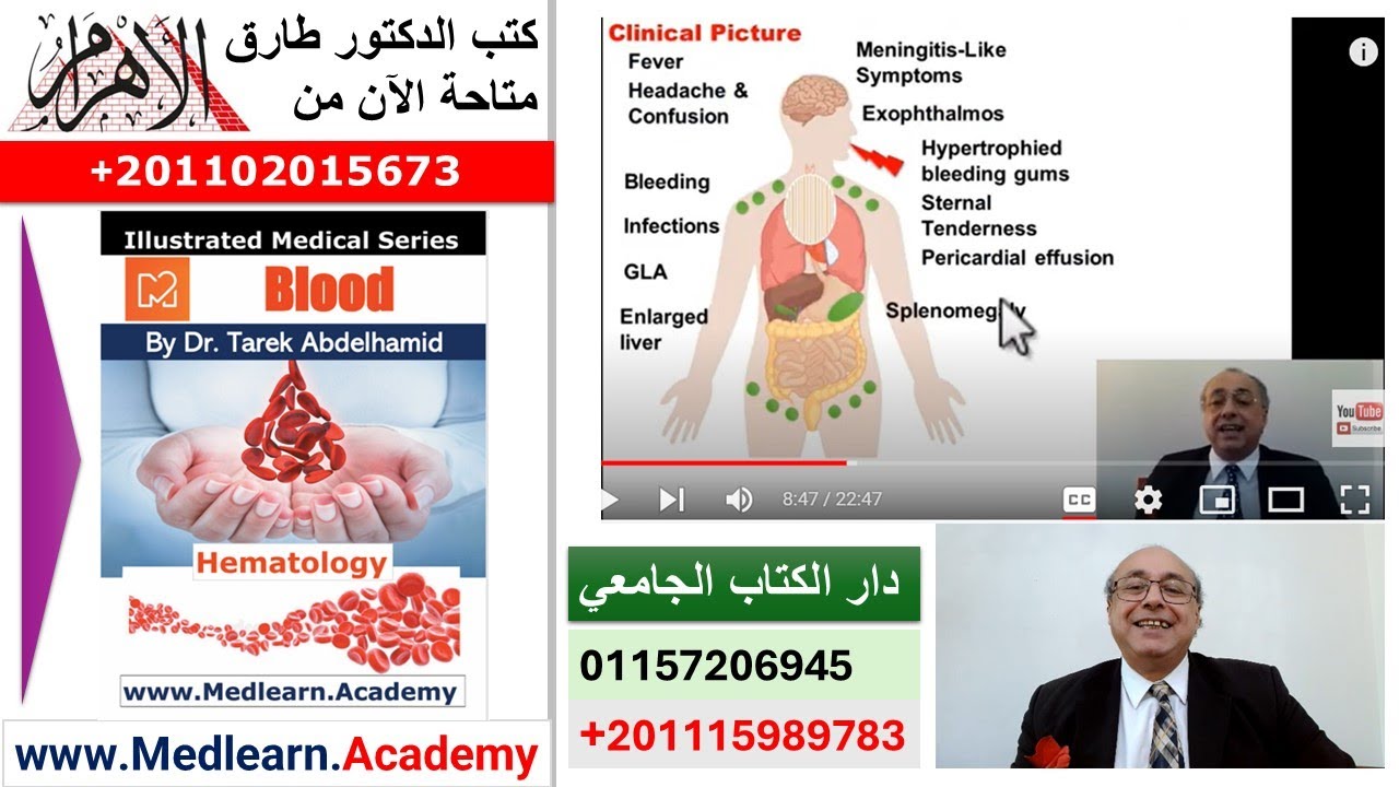 Acute Myeloid Leukemia (AML) #cme #internal_medicine #medical #usmle #محاضرات_باطنة #USMLE