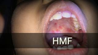 Hand, foot & mouth disease, it