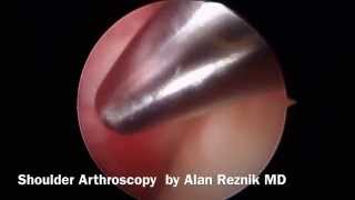 Intro to Shoulder Arthroscopy Rotator Cuff Tear Anatomy