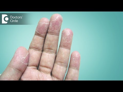 Ways to manage peeling of skin from hands - Dr. Sudheendra Udbalker