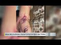 Pensacola Surgeons Save Orange Beach Man S Hand From Flesh Eating Bacteria