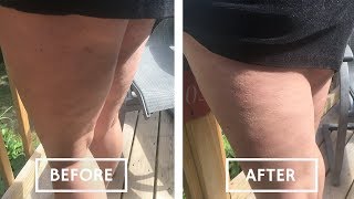 Get Rid Of Cellulite FAST And Naturally