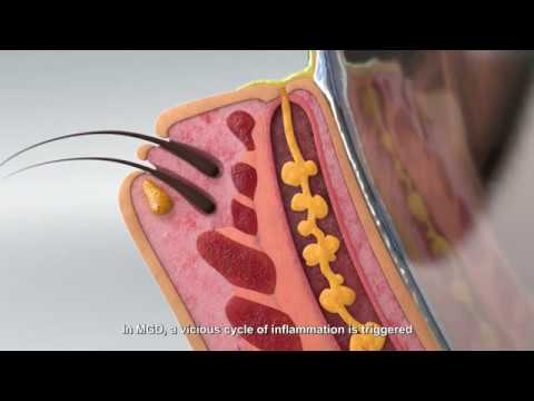 Intense Pulsed Light for MGD - eyeLABS Dry Eye Clinic