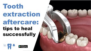 Tooth extraction aftercare: Tips to heal successfully.